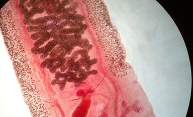 Anquilostomosis in humans