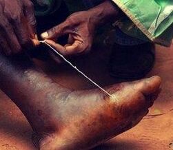 Parasite in a person's foot