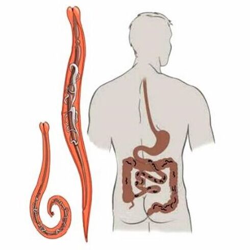 Worms in the human intestine